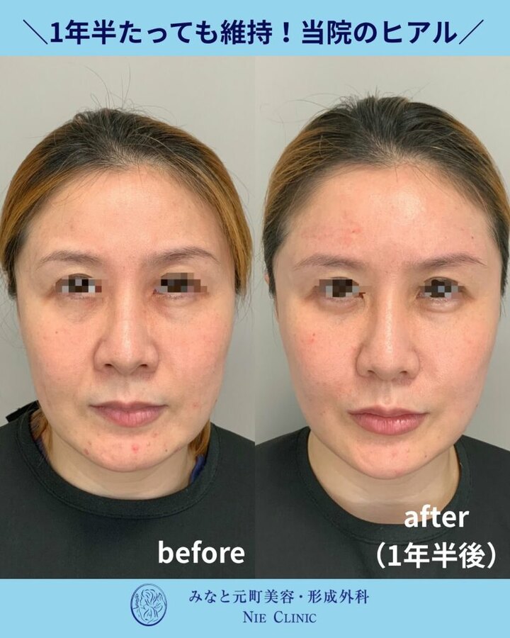 ヒアルロン酸注入から1年半後のしわ・たるみ治療経過を比較した症例写真