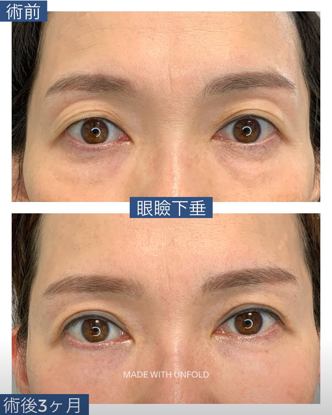 眼瞼下垂の術前術後3か月の症例写真