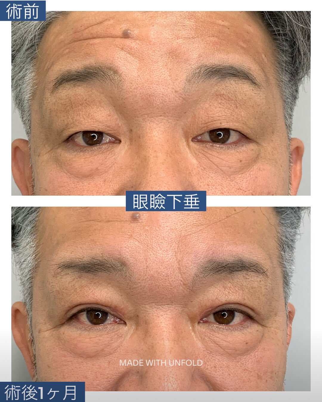 眼瞼下垂の術前術後1か月の症例写真