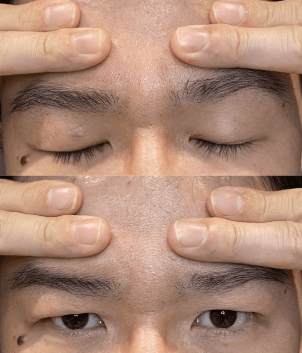 眼瞼下垂の予防で上まぶたを鍛える方法