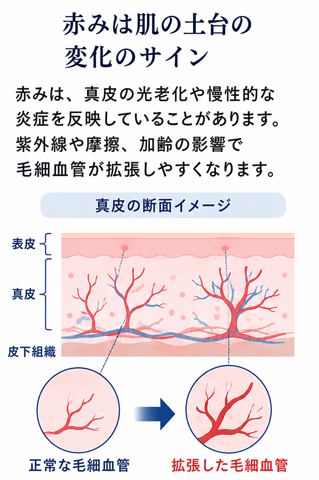 赤みと真皮の光老化、慢性的な炎症、毛細血管拡張の関係を示す図