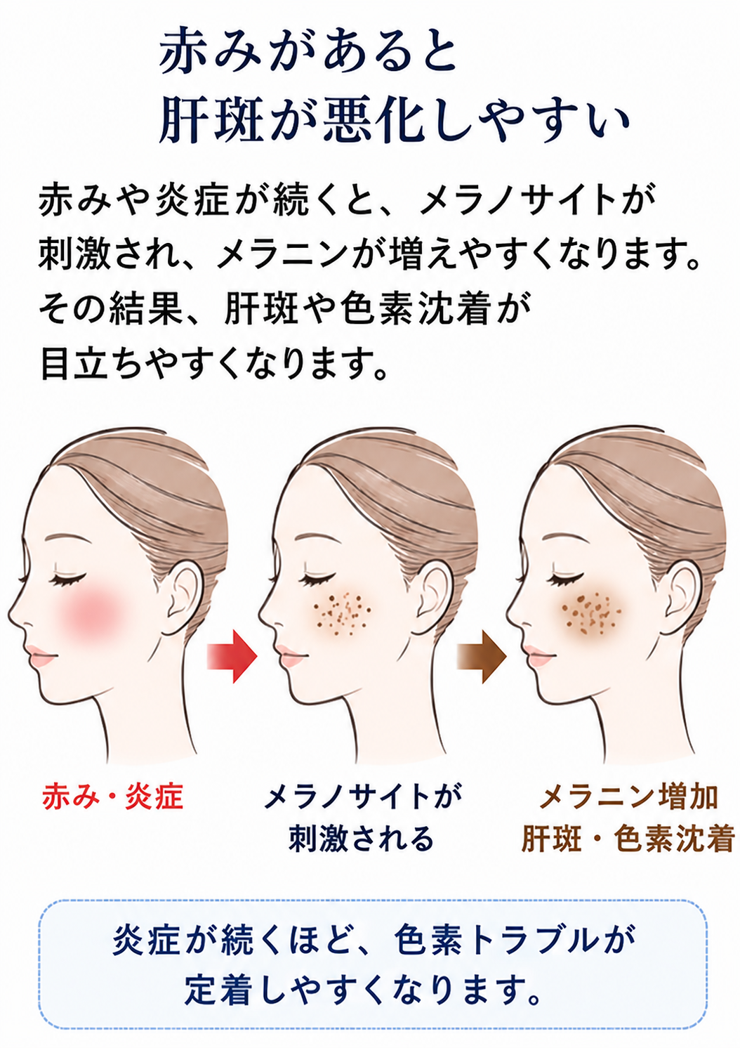 赤みや炎症がメラノサイトを刺激し肝斑や色素沈着に関わる説明図