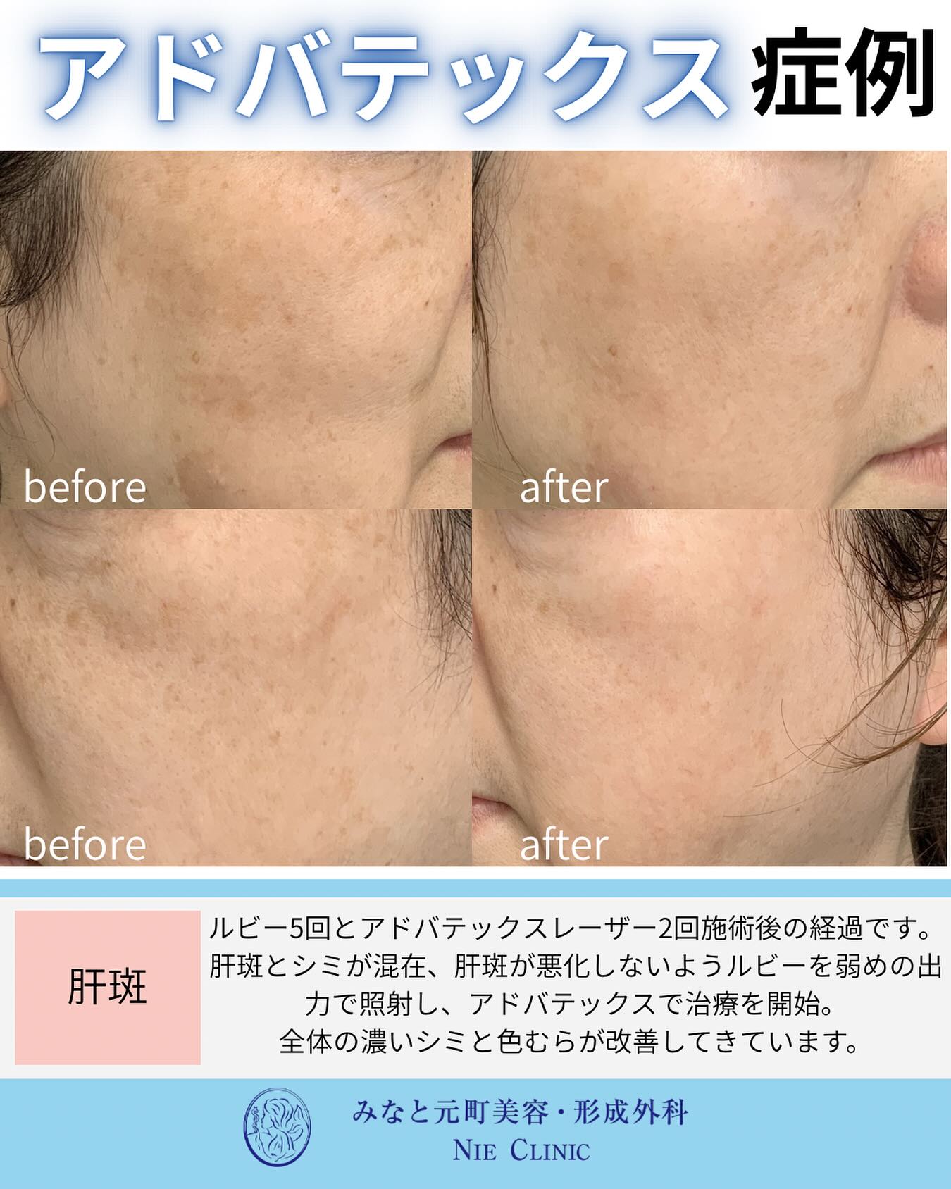 肝斑・シミへルビー5回とアドバテックス2回を併用した症例