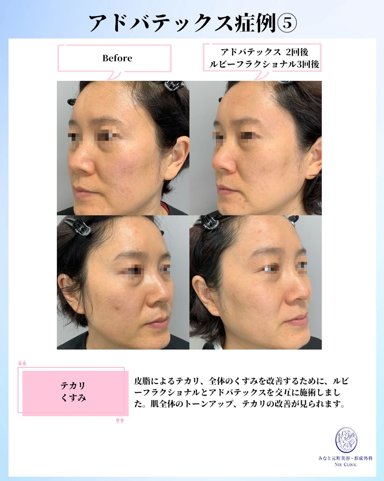 皮脂・テカリ・くすみへアドバテックスとルビートーニングを併用した症例
