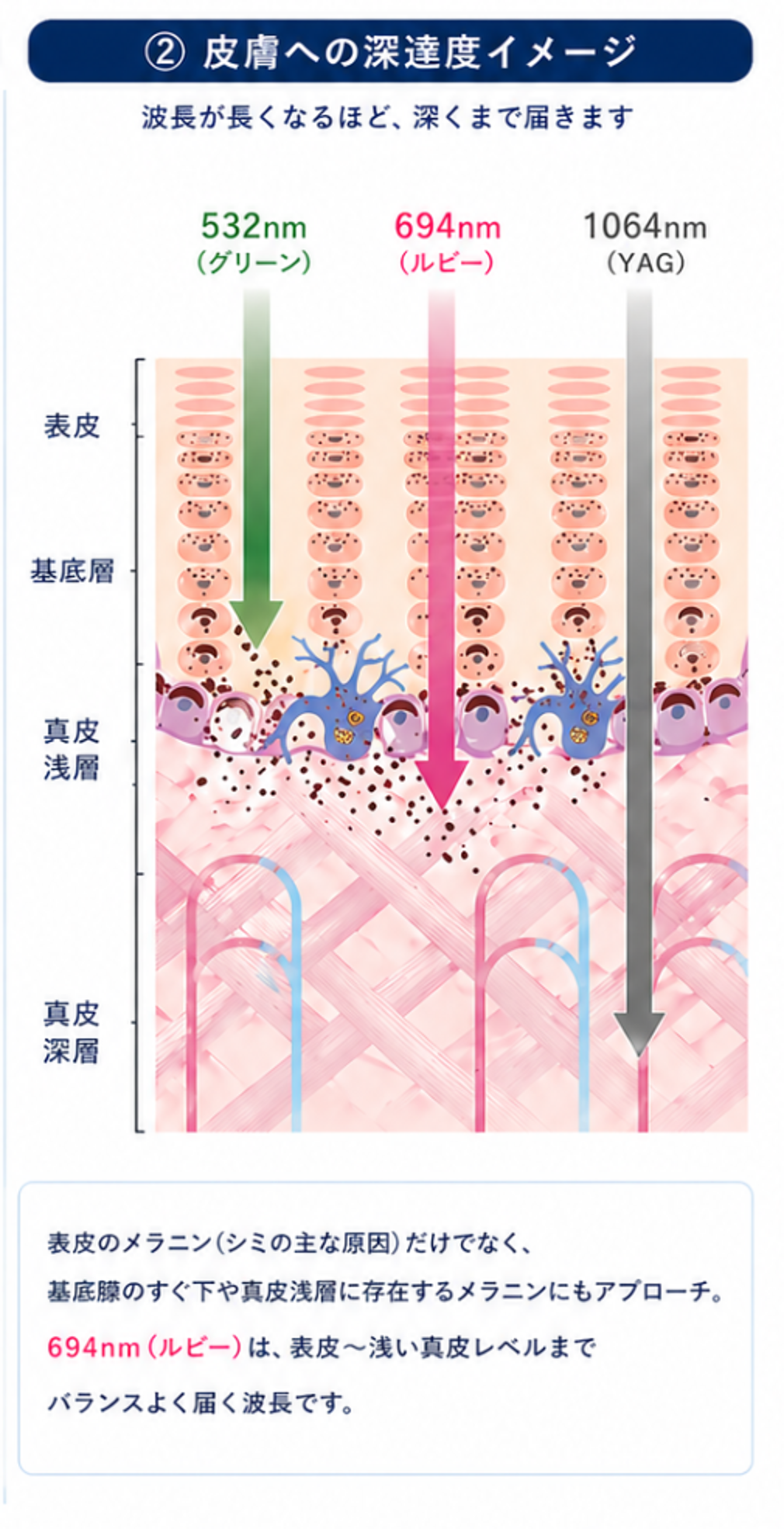 532nm・694nm・1064nmレーザーの皮膚への深達度を比較した図