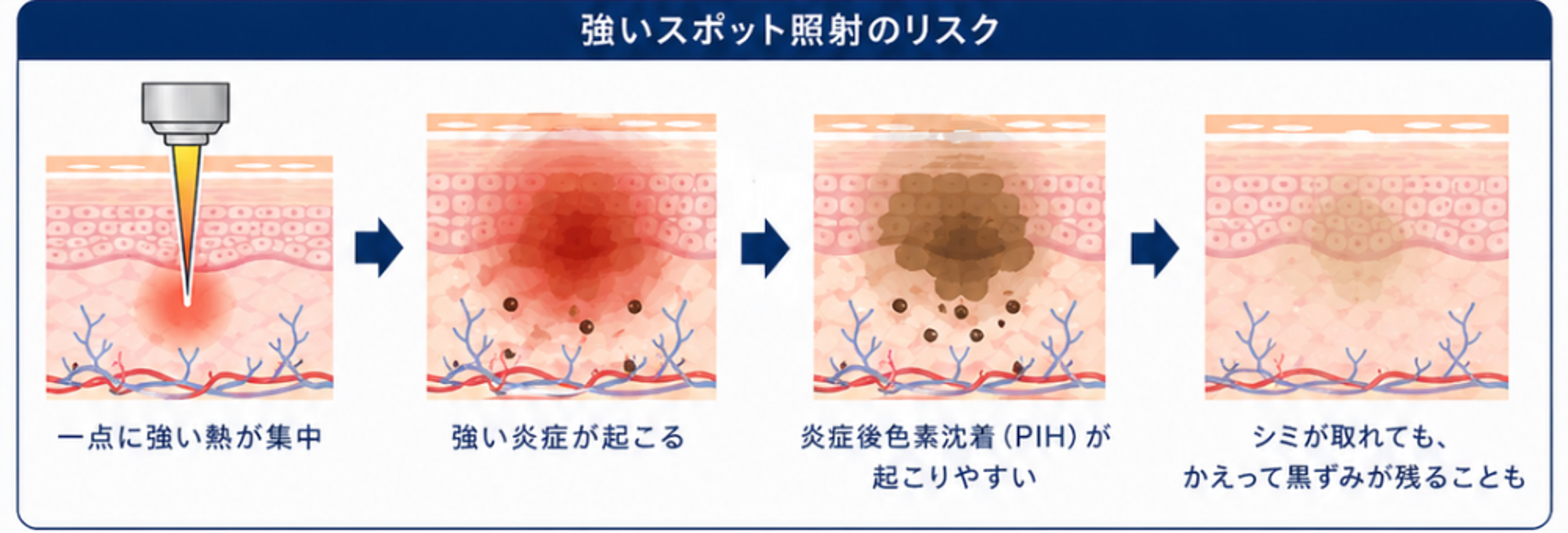 強いスポット照射で炎症と炎症後色素沈着が生じる流れを示した図