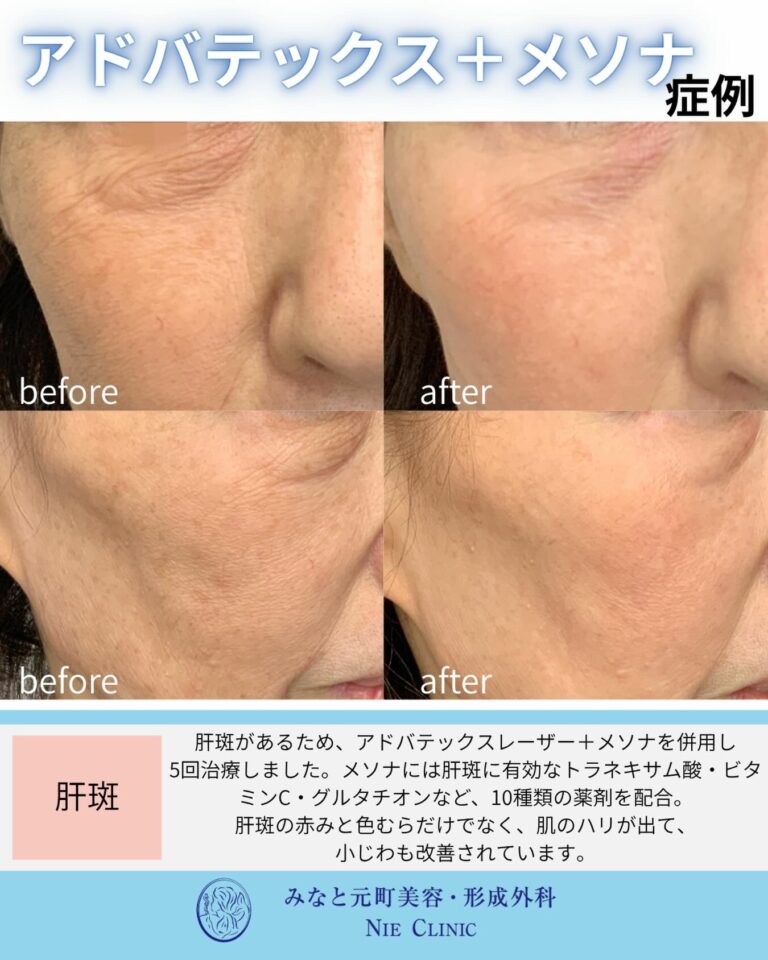 ADVATxとメソナJ各5回後の頬の肝斑・赤み・色むらを比較する症例写真