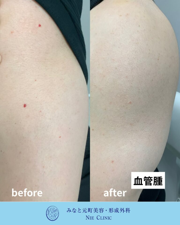 腕の赤い血管性病変の隆起と色調を比較する治療前後写真