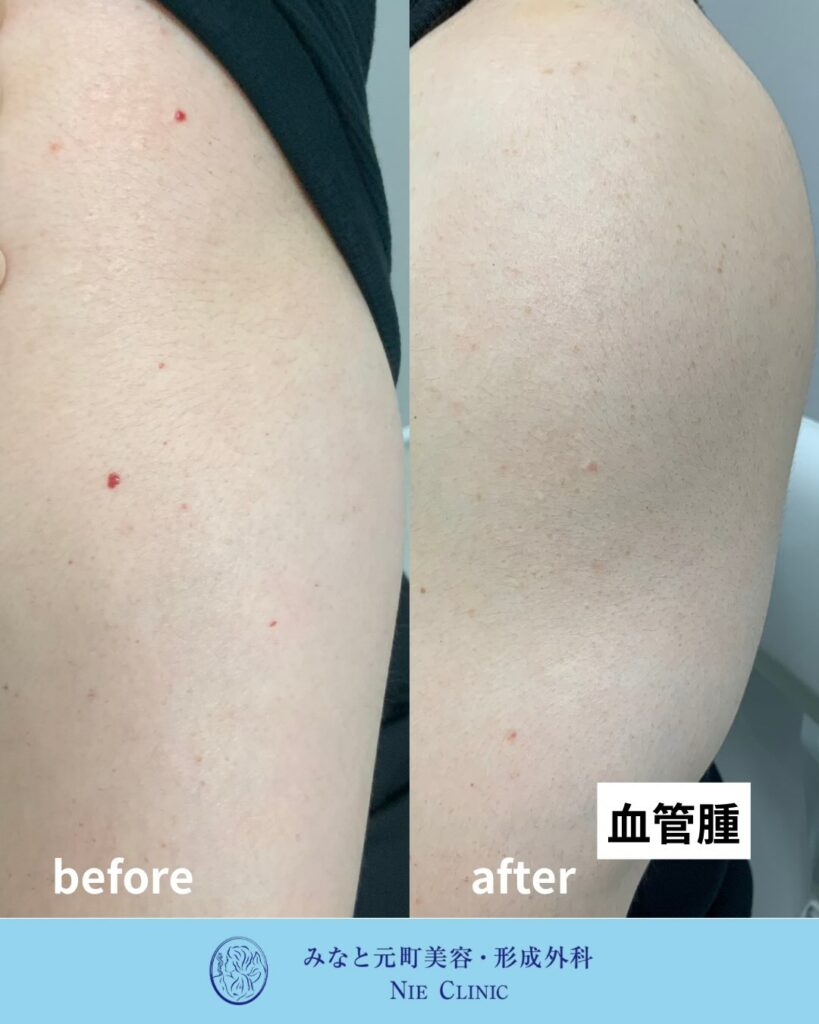 腕の赤い血管性病変の隆起と色調を比較する治療前後写真