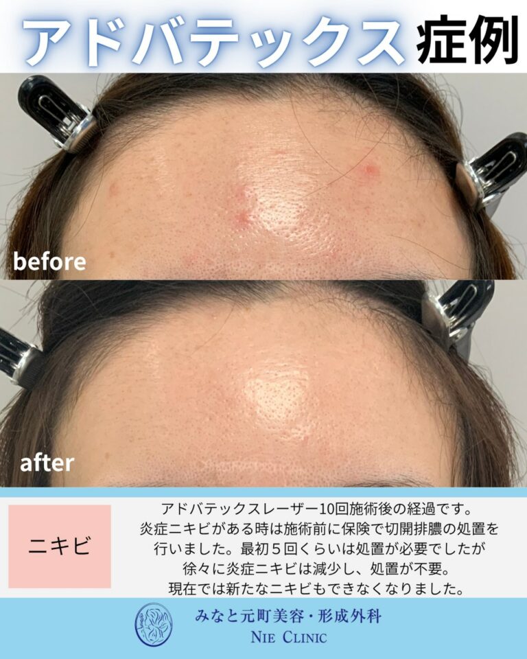 ADVATx 10回と前半5回の切開排膿後に炎症性ニキビと赤みを比較する症例写真