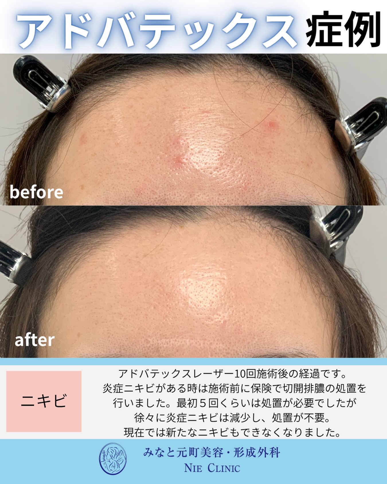 ADVATx 10回と前半5回の切開排膿後に炎症性ニキビと赤みを比較する症例写真