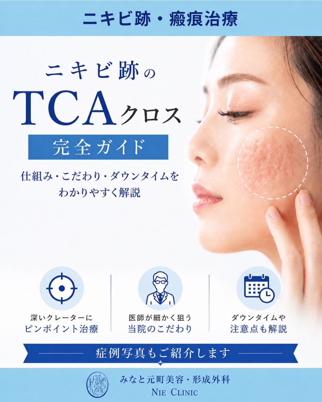 深いニキビ跡へTCA CROSSを行う仕組み・注意点・症例を案内する表紙