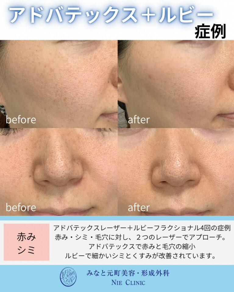 ADVATxとルビーフラクショナル各4回後の赤み・シミ・毛穴を比較する症例写真