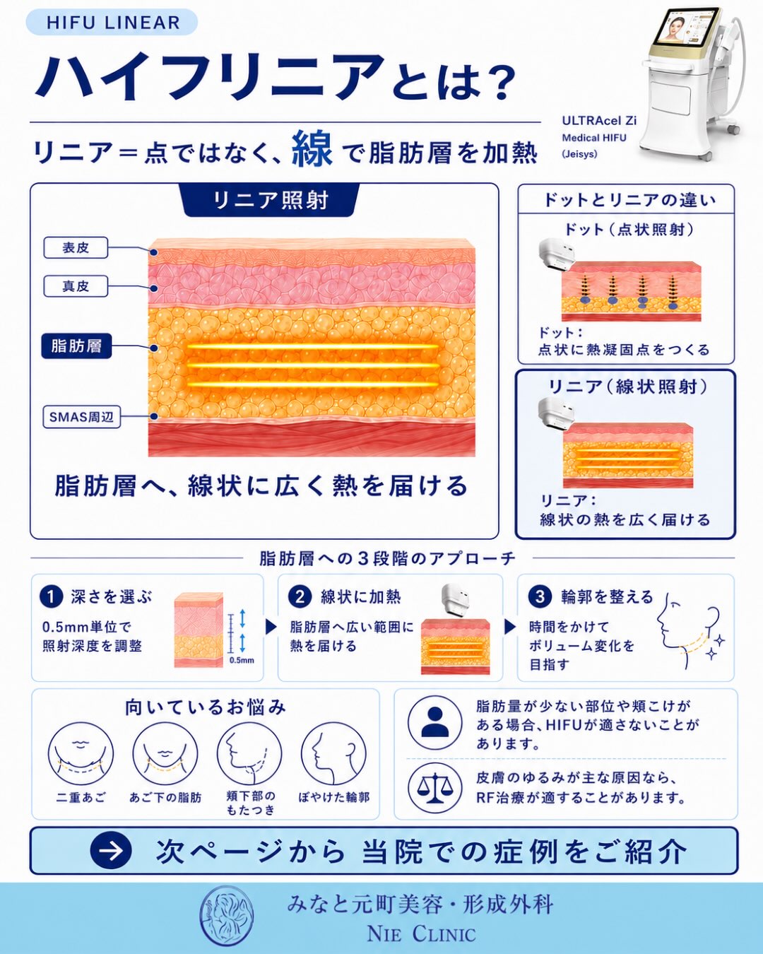 HIFUリニアの0.5mm単位の深度調整・脂肪層3段階加熱・ドット照射との違いを示す図解