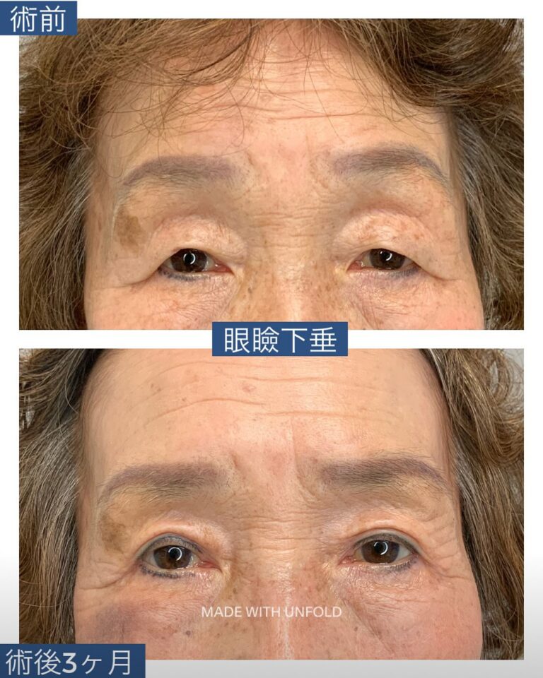眼瞼下垂手術前と術後3か月の上まぶたの開きと左右差を比較する症例写真
