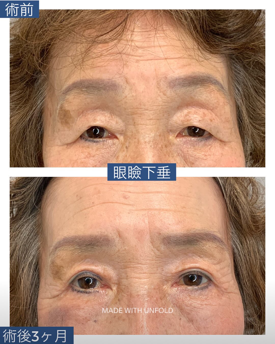 眼瞼下垂手術前と術後3か月の上まぶたの開きと左右差を比較する症例写真