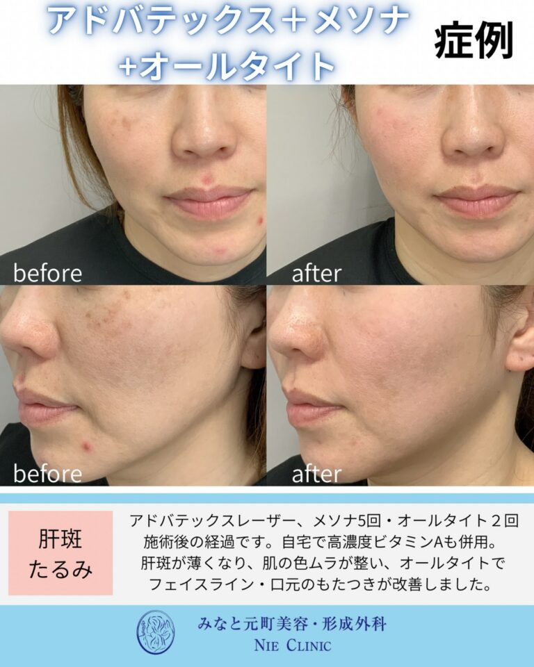 ADVATx・メソナJ 5回とAlltite 2回後の肝斑・色むら・フェイスライン症例写真