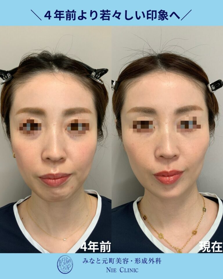 4年前と現在の正面写真で顔全体の輪郭と肌印象を比較する長期経過写真
