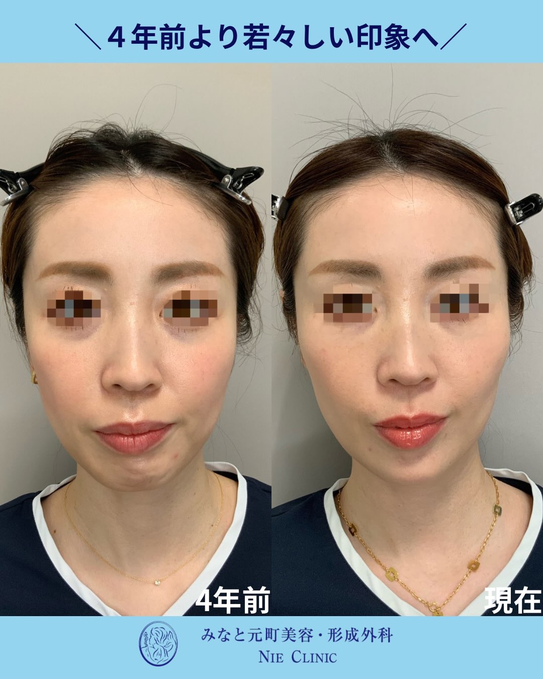4年前と現在の正面写真で顔全体の輪郭と肌印象を比較する長期経過写真