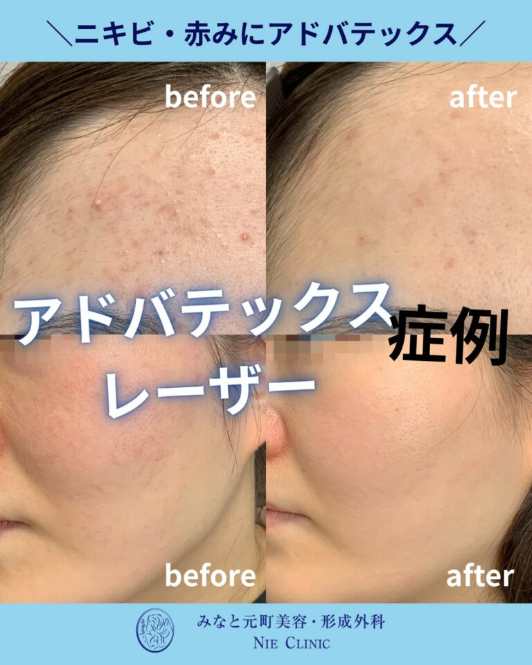 ADVATxによるニキビと赤みの治療前後を紹介する症例集表紙