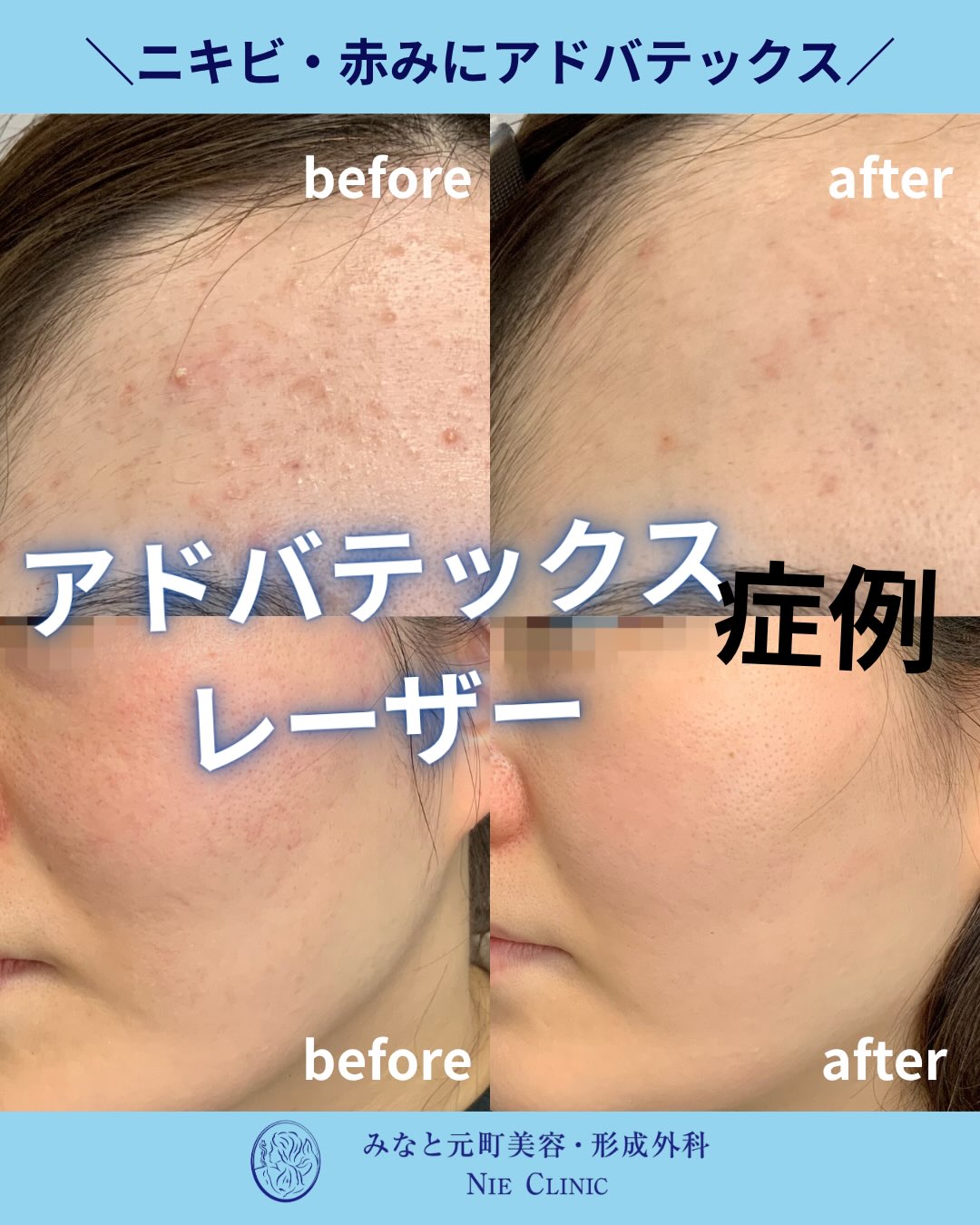 ADVATxによるニキビと赤みの治療前後を紹介する症例集表紙