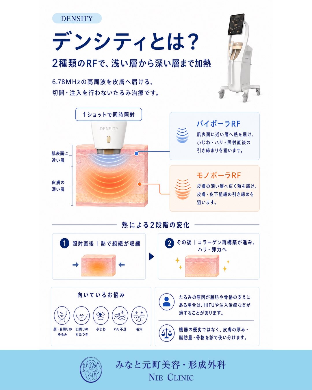 DENSITYのバイポーラRFとモノポーラRFが熱を届ける皮膚層の模式図