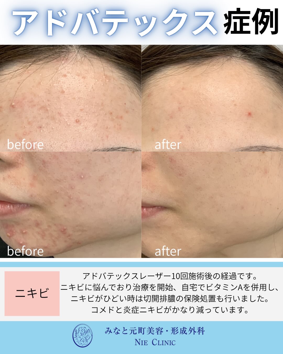 ADVATx10回・ビタミンA・切開排膿を組み合わせたニキビ症例写真