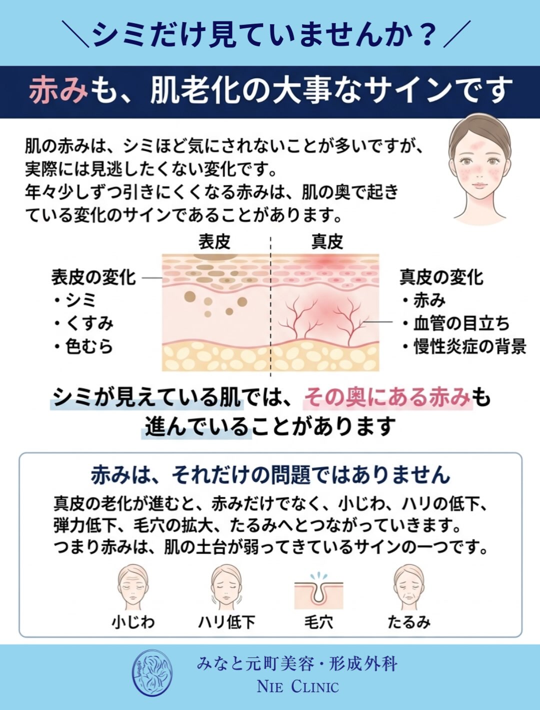 表皮のシミ・くすみと真皮の赤み・血管を分けて観察する皮膚断面図