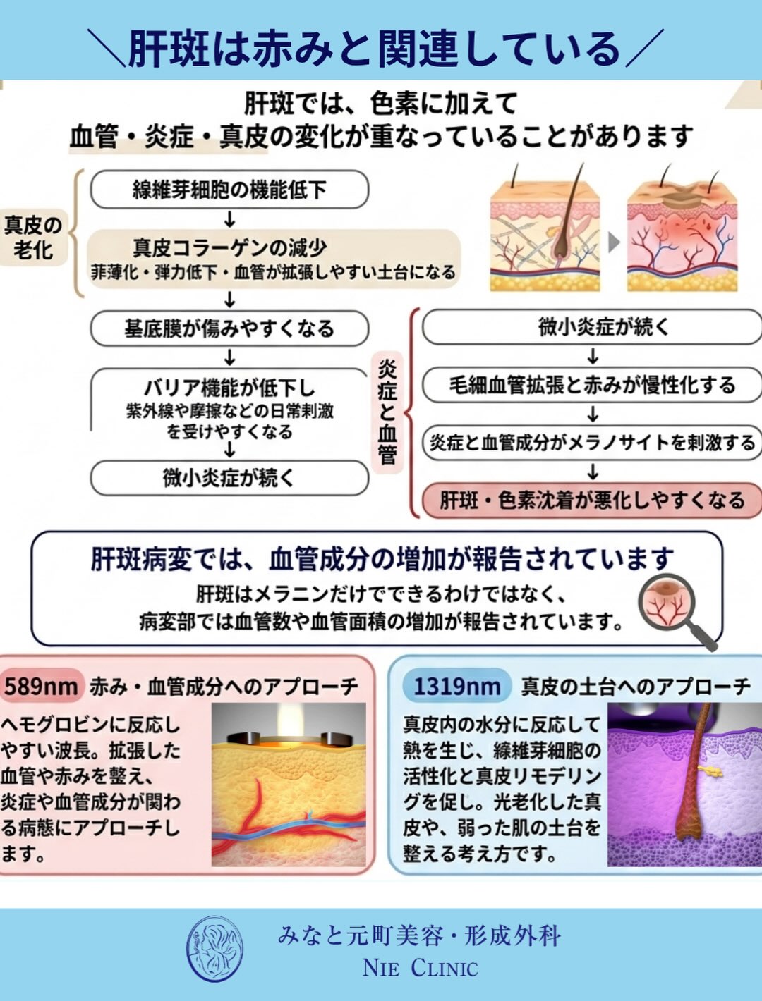 肝斑に血管・炎症・真皮変化が重なる経路を示す模式図