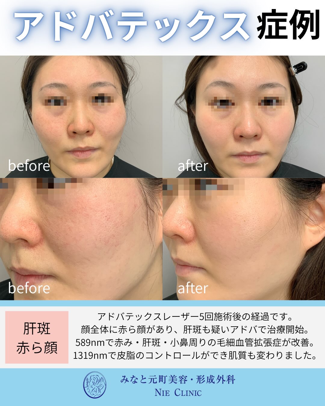 ADVATx5回後の顔全体の赤み・肝斑・小鼻の毛細血管を比較する症例写真