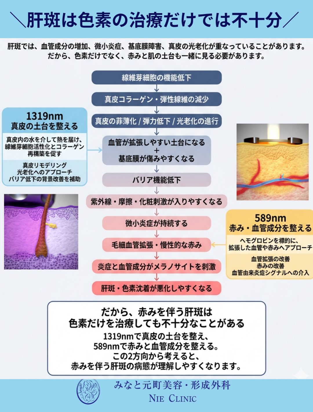 589nmで血管、1319nmで真皮を扱うADVATxの二波長治療図