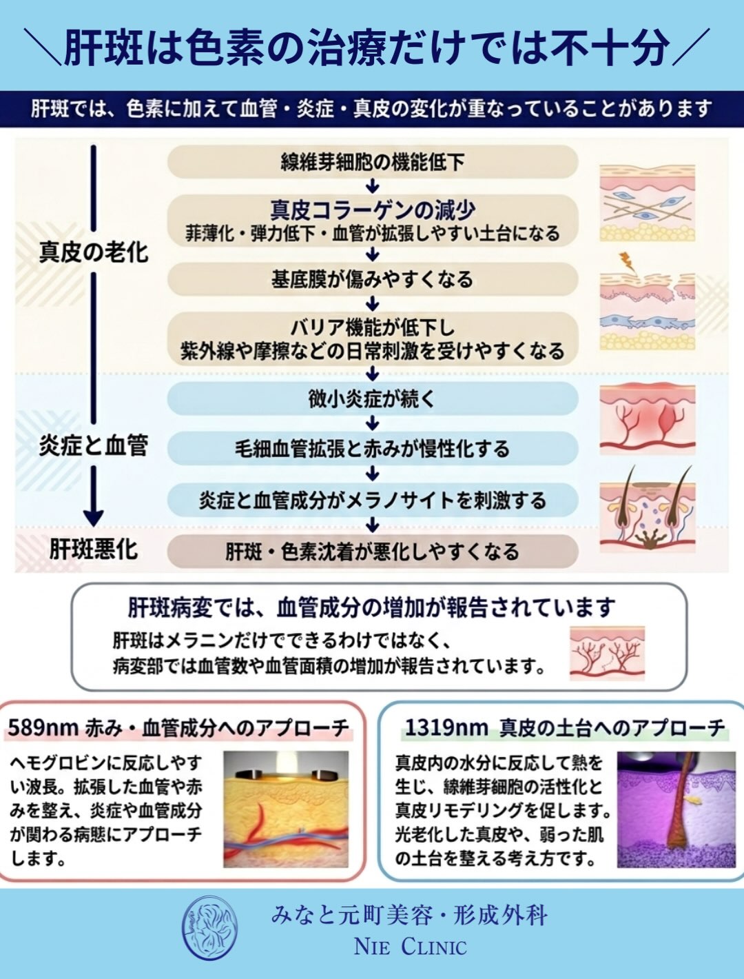 肝斑悪化に真皮老化・基底膜障害・微小炎症が関わる流れを示す図解