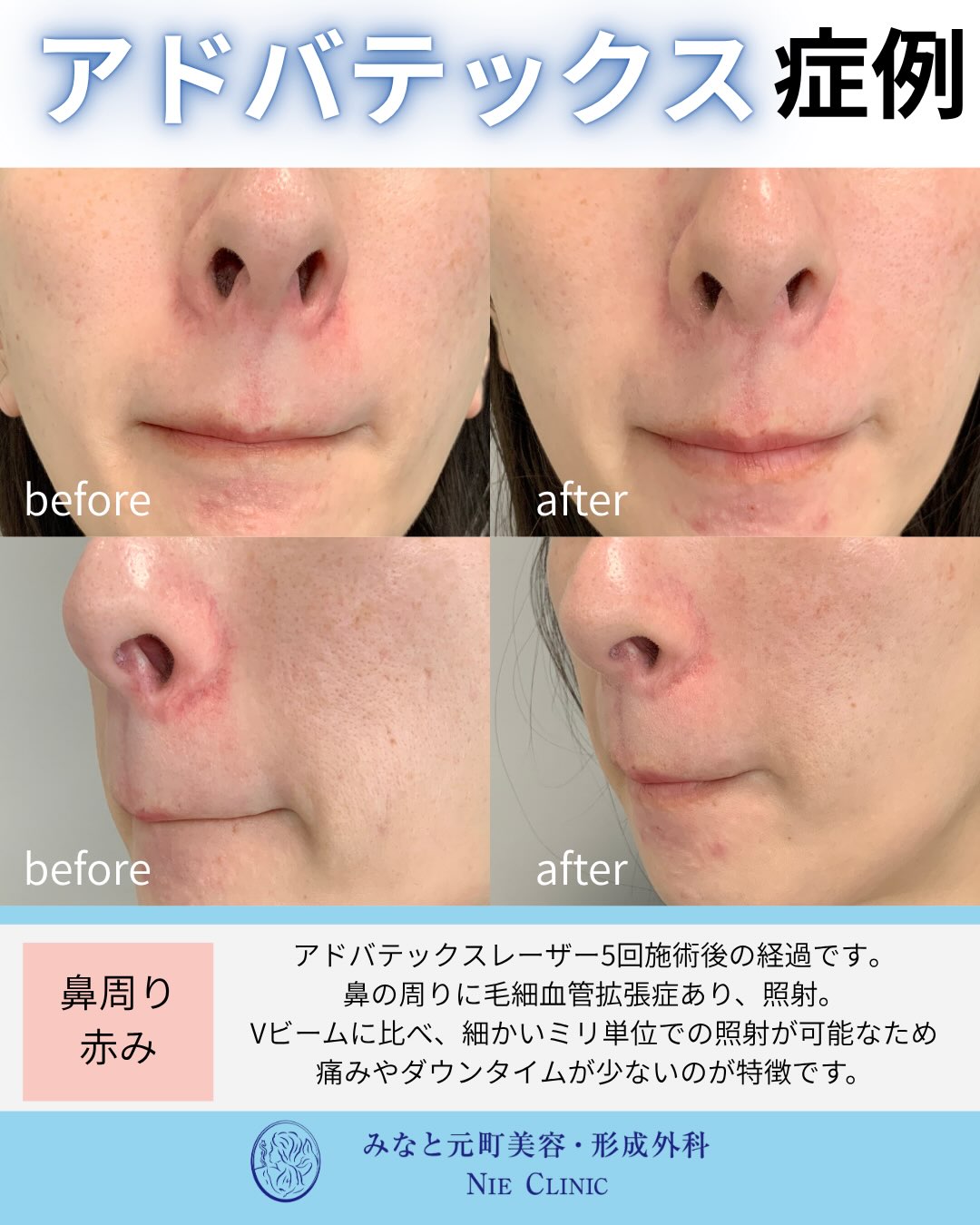 ADVATx5回後の鼻周囲の毛細血管拡張と赤みを比較する症例写真