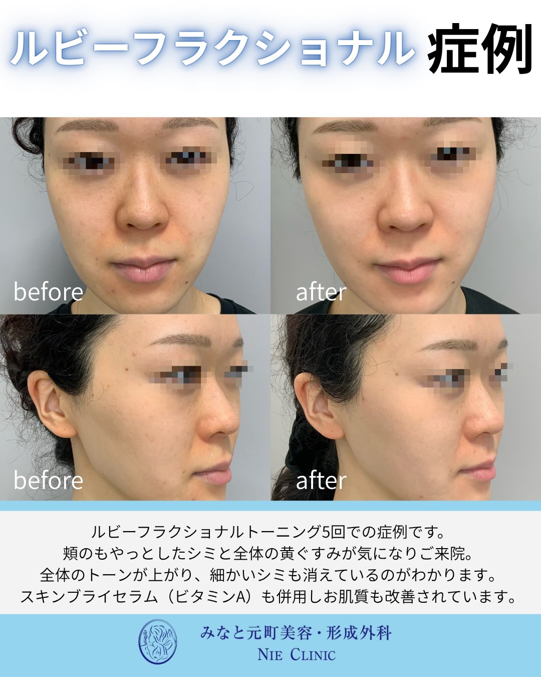 ルビーフラクショナル5回とビタミンAを併用した頬のシミ・黄ぐすみ症例写真
