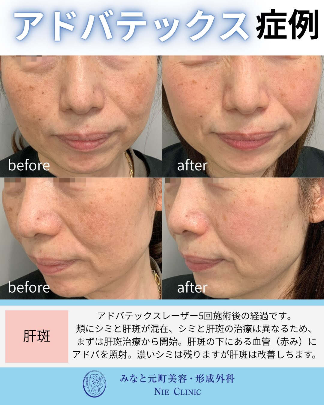 シミと肝斑が混在する頬へADVATx5回を行った症例写真