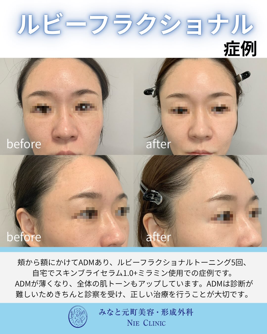 ADMへルビーフラクショナル5回とホームケアを行った額・頬の症例写真