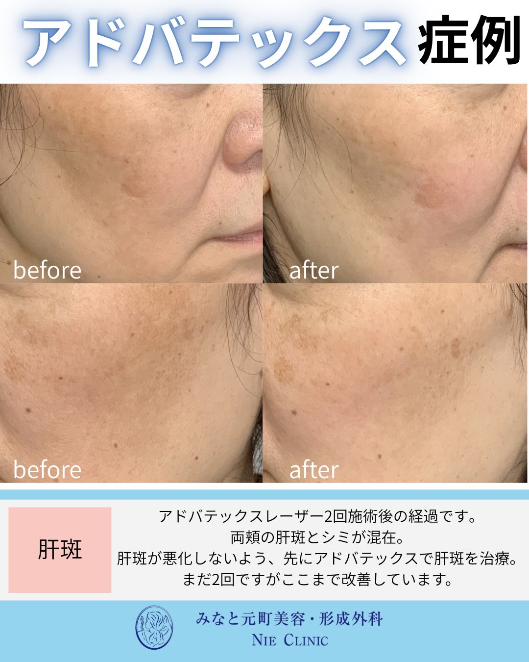 両頬の肝斑とシミが混在する肌へADVATx2回を行った症例写真