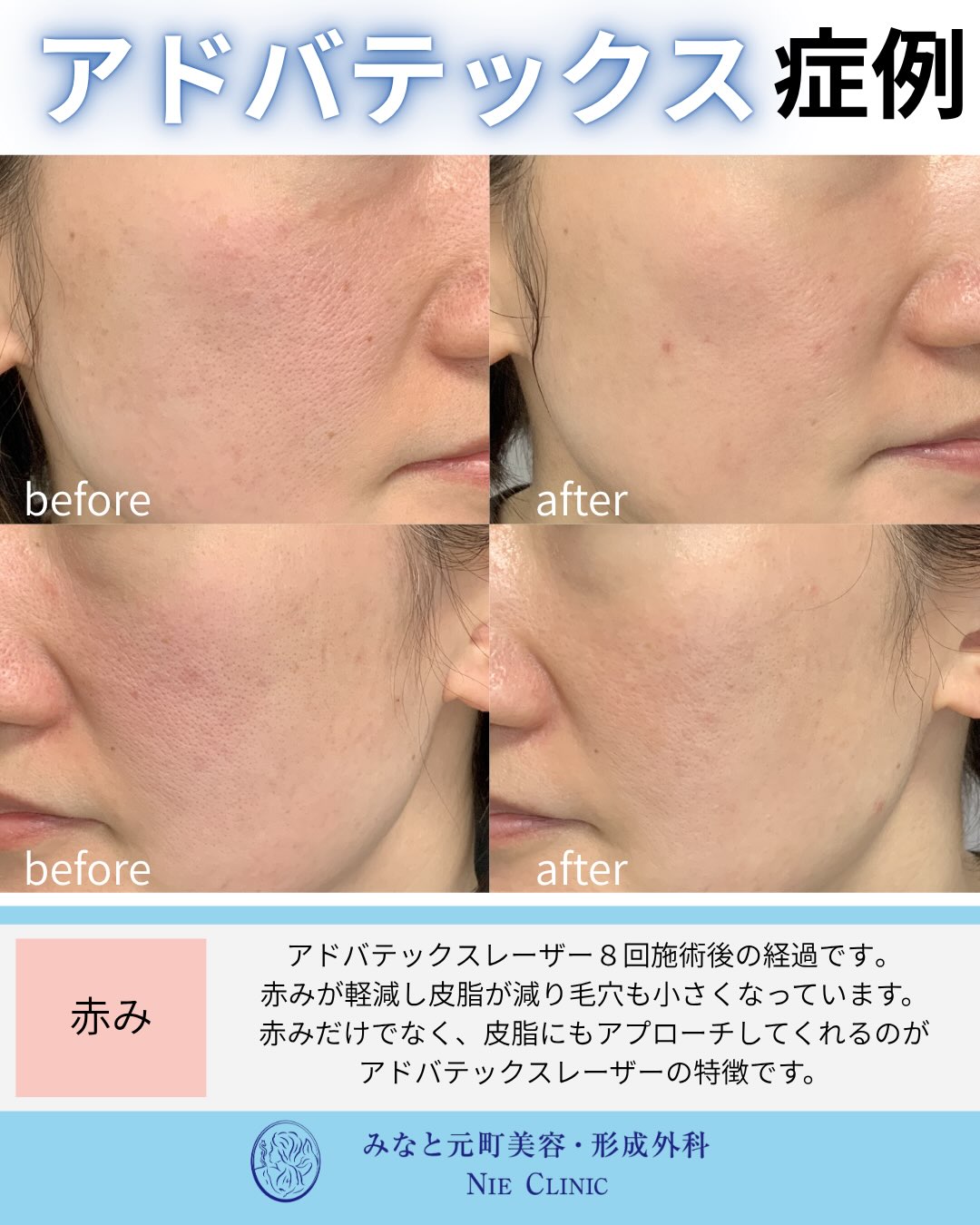 ADVATx8回後の全顔の赤み・皮脂・毛穴を比較する症例写真