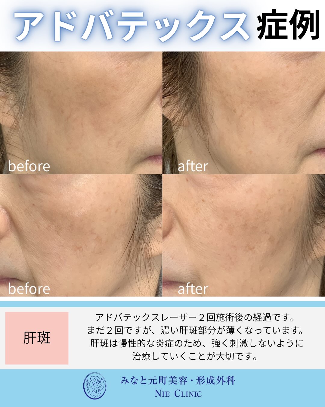 頬の濃い肝斑へADVATx2回を行った途中経過の症例写真