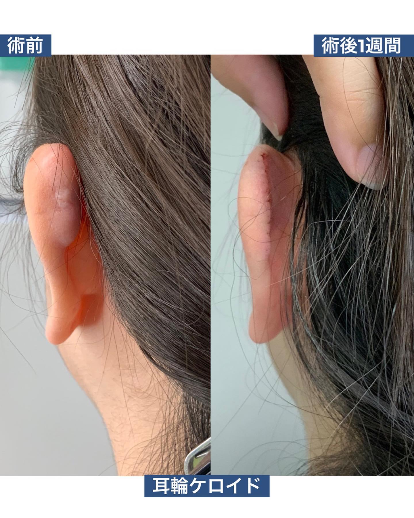 穿耳洞后耳轮瘢痕疙瘩切除前与术后1周的案例照片