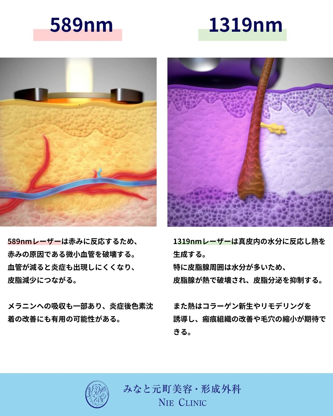 589nmが微小血管と赤み、1319nmが真皮・皮脂腺・毛穴へ作用する違いを示した図
