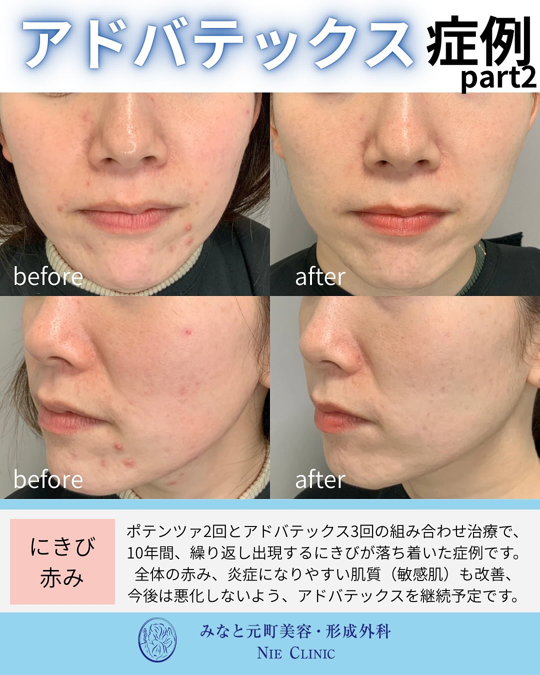 10年間繰り返すニキビと赤みにポテンツァ2回・アドバテックス3回を行った前後比較写真