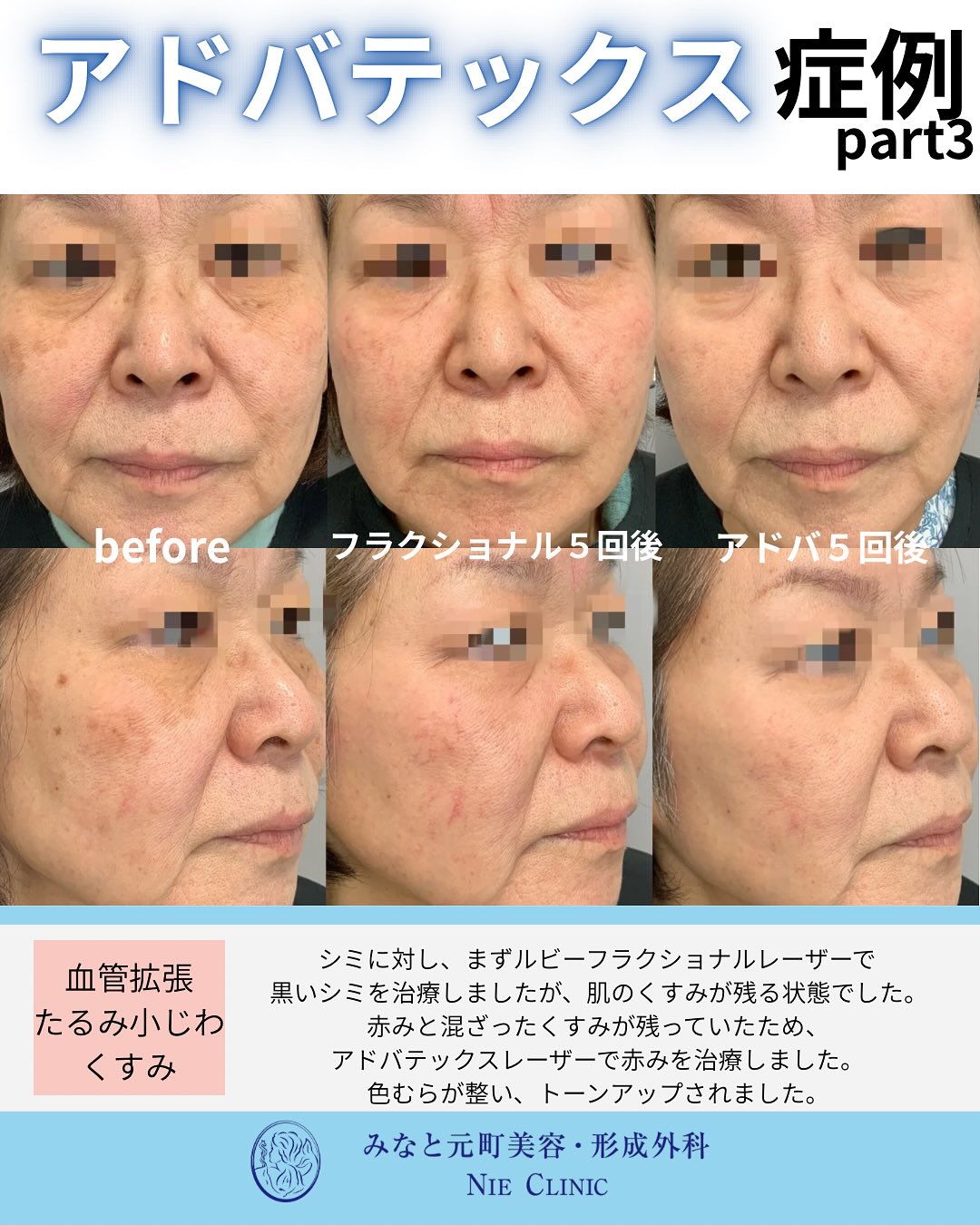 シミ・血管拡張・くすみにルビーフラクショナル5回後とアドバテックス5回後を比較した写真