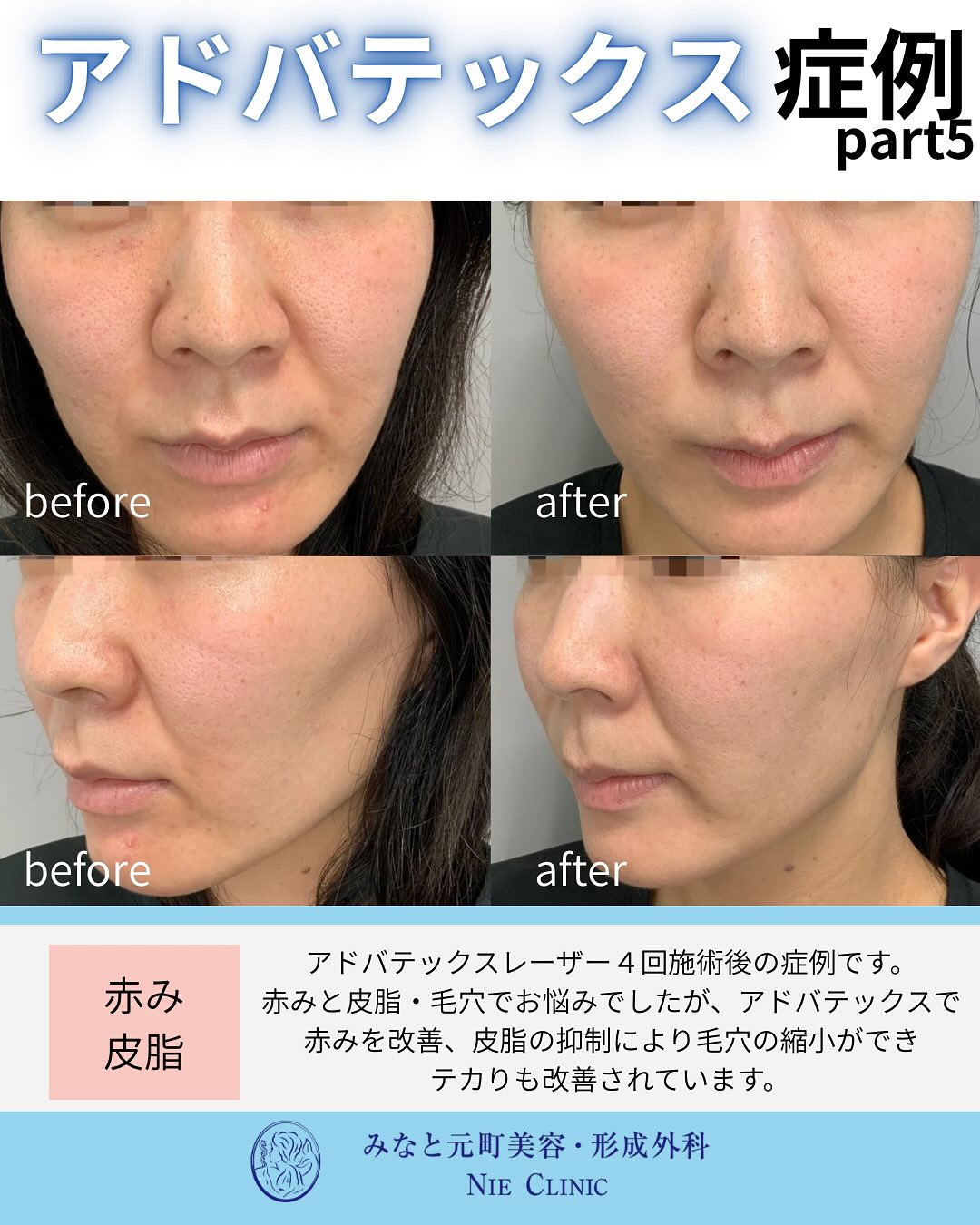 顔の赤み・皮脂・毛穴・テカリにアドバテックスを4回施術した前後比較写真