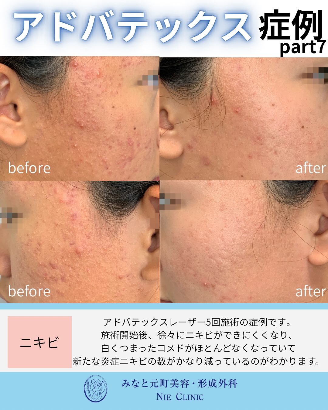 白い面皰と炎症性ニキビにアドバテックスを5回施術した左右頬の前後比較写真