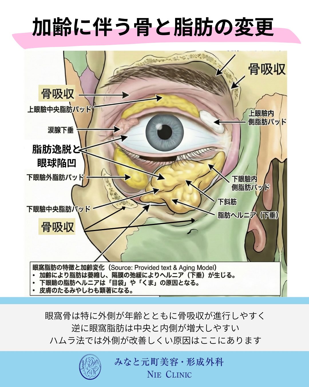 加齢による眼窩骨吸収・眼窩脂肪逸脱・眼球陥凹を示す図