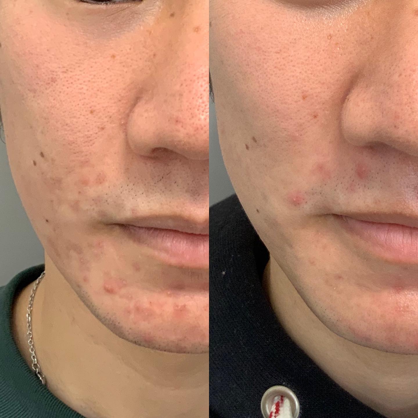 ポテンツァのニキビチップ全顔1回前後の頬・毛穴拡大比較