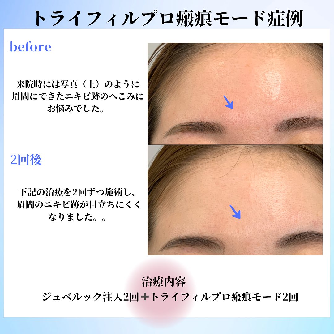 眉間のニキビ跡へジュベルック注入2回とトライフィルプロ瘢痕モード2回前後を比較