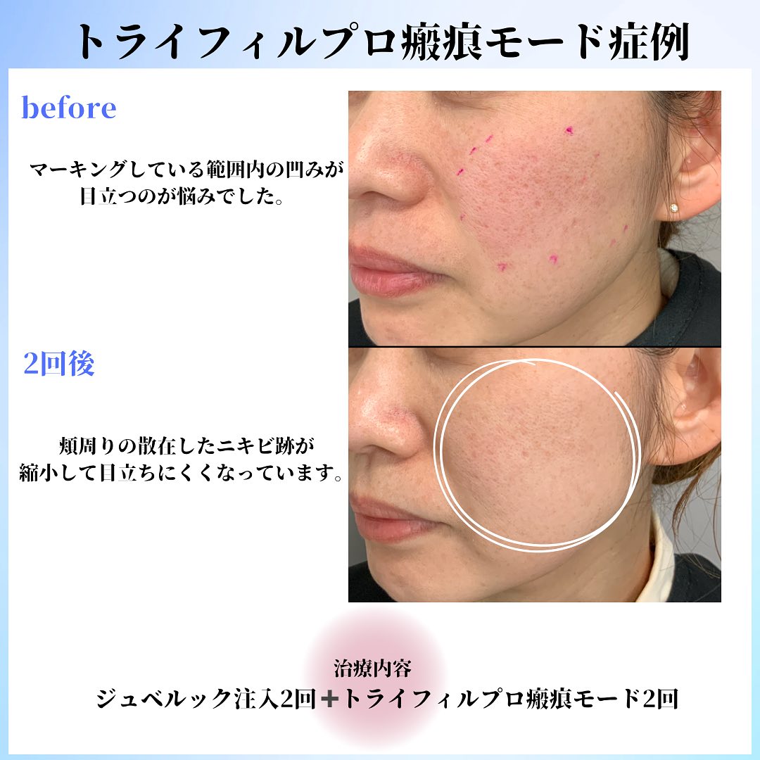 右頬斜位の散在するニキビ跡をジュベルック注入2回・瘢痕モード2回前後で比較