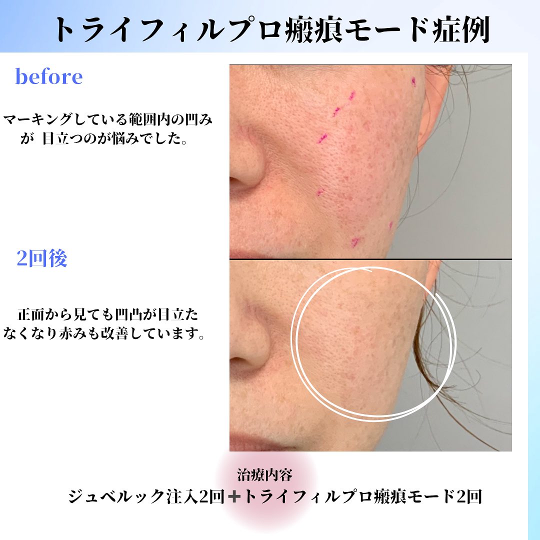 右頬正面のニキビ跡と赤みをジュベルック注入2回・瘢痕モード2回前後で比較